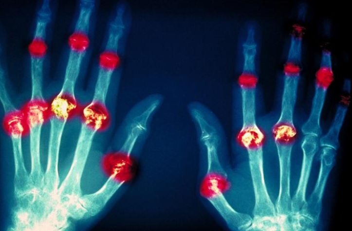 Ces découvertes sur le lupus et la polyarthrite rhumatoïde suggèrent de nouvelles cibles du système immunitaire qui méritent d'être approfondies. Ces découvertes sur le lupus et la polyarthrite rhumatoïde suggèrent de nouvelles cibles du système immunitaire qui méritent d'être approfondies.