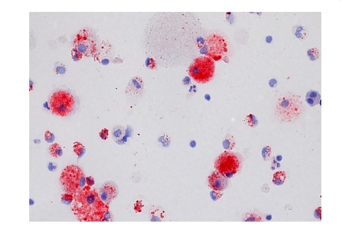 La protéinose alvéolaire pulmonaire est caractérisée par l'accumulation d'une substance composée notamment de cholestérol (en rouge sur visuel) dans les espaces aériens distaux