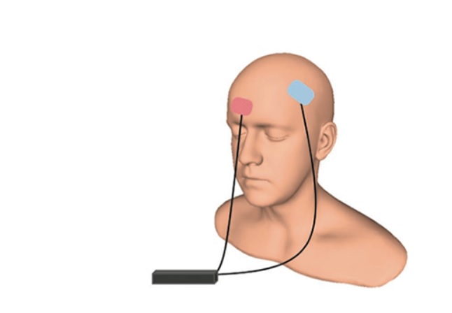 L'utilisation d'un courant électrique pour stimuler cette zone -par stimulation transcrânienne à courant continu (tDCS)- améliore la capacité des patients à se souvenir.