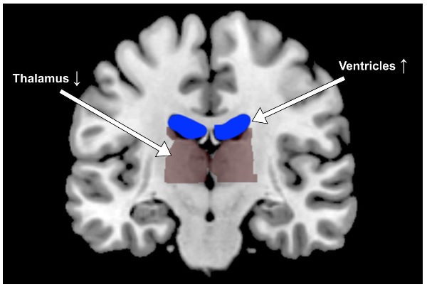 La déshydratation impacte la forme et l'activité du cerveau humain