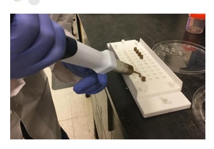 La transplantation de microbiote fécal est ici testée chez des patients ces patients atteints de cirrhose et d'encéphalopathie hépatique récurrente La transplantation de microbiote fécal est ici testée chez des patients ces patients atteints de cirrhose et d'encéphalopathie hépatique récurrente