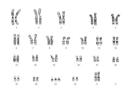 La trisomie 21, ou syndrome de Down, est une maladie génétique lourde caractérisée par l'addition d'un troisième chromosome 21.