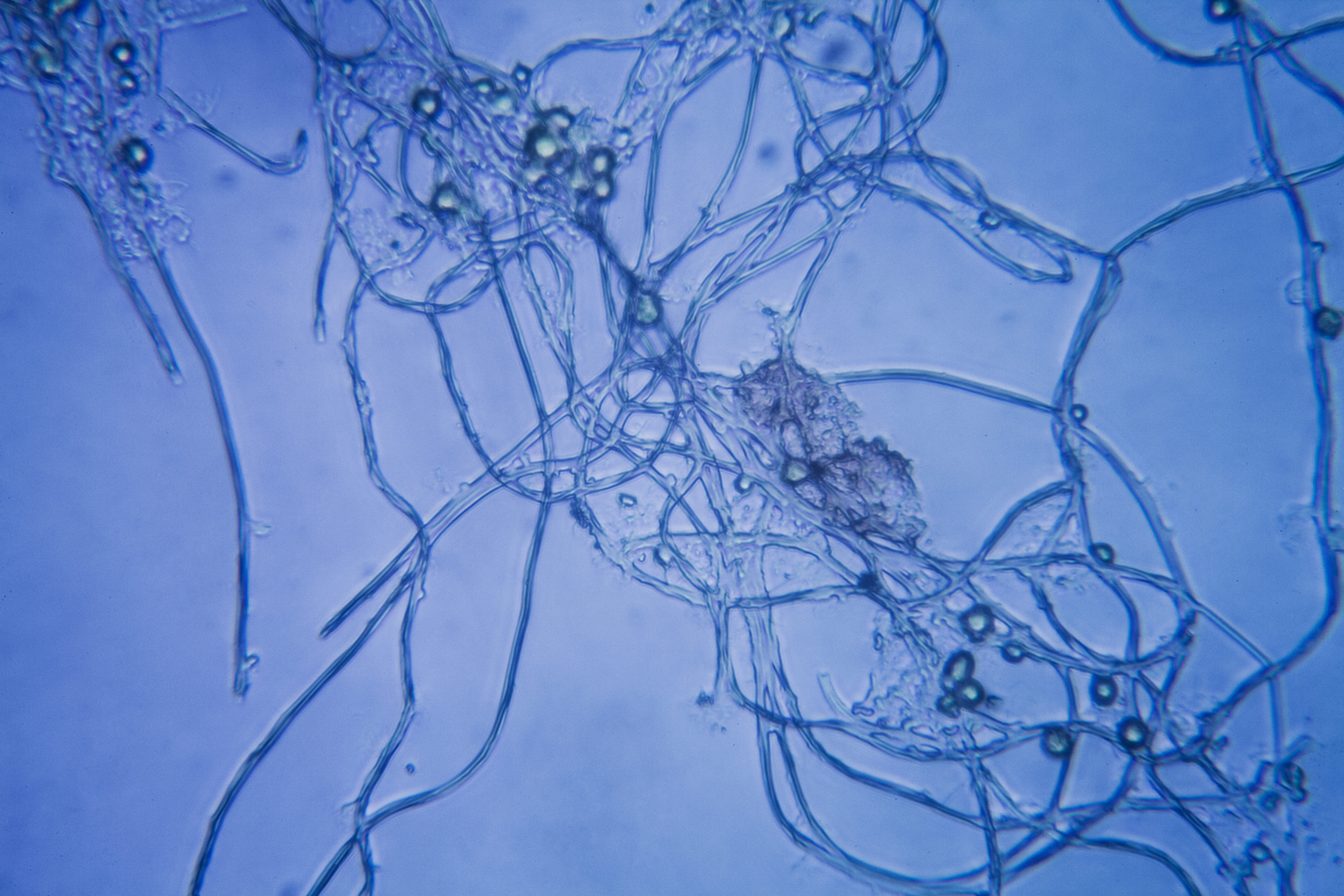 Dans les cas de la tête et du cou, la « moisissure » pénètre généralement par les voies respiratoires impliquant le nez et les sinus, avec une progression possible dans les structures orbitales et intracrâniennes (Visuel Adobe Stock 194523431) Dans les cas de la tête et du cou, la « moisissure » pénètre généralement par les voies respiratoires impliquant le nez et les sinus, avec une progression possible dans les structures orbitales et intracrâniennes (Visuel Adobe Stock 194523431)