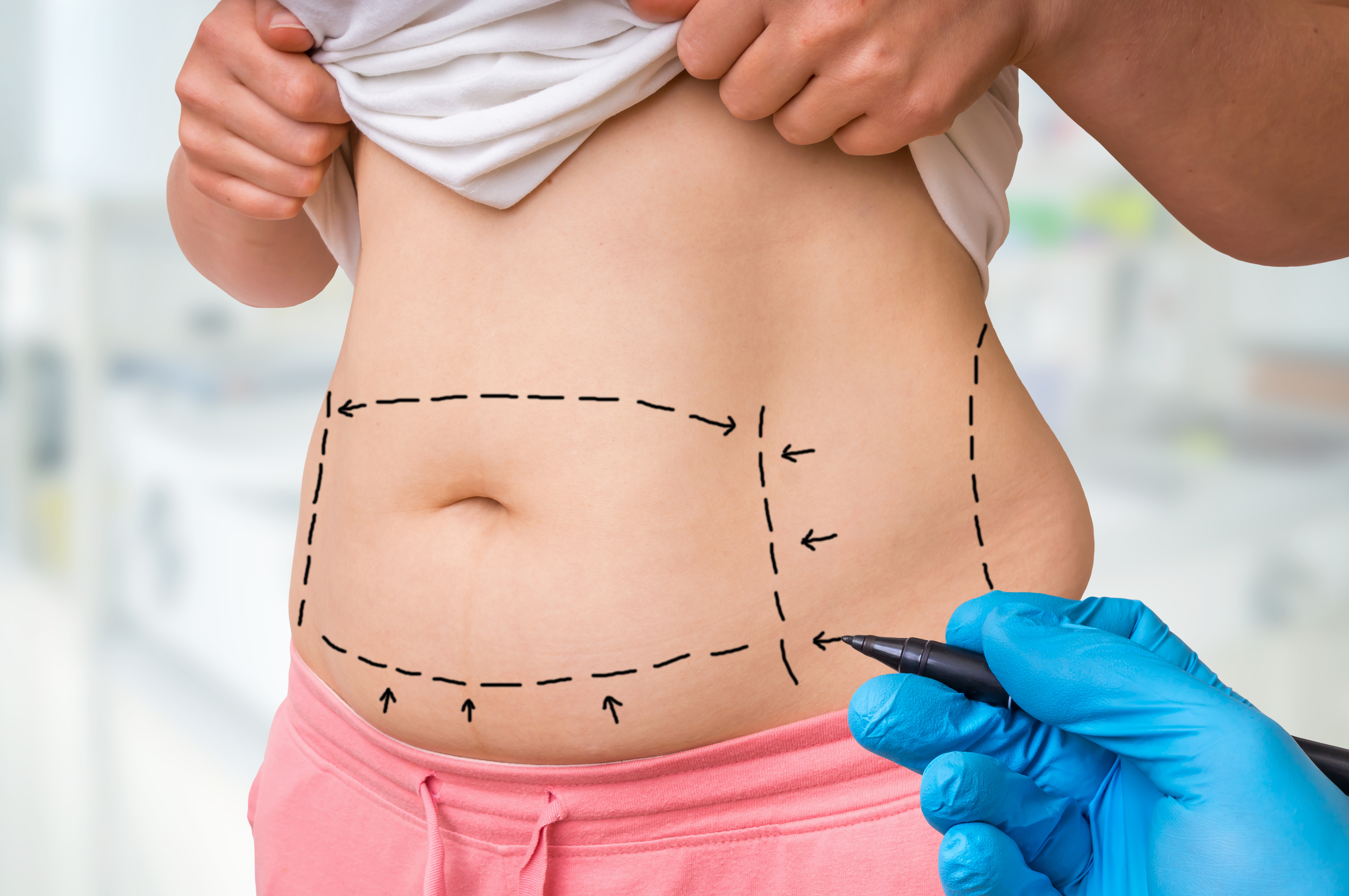 Enfin, si la liposuccion est généralement une procédure sûre, elle peut entraîner de très rares effets indésirables (Visuel Adobe Stock 219739310) Enfin, si la liposuccion est généralement une procédure sûre, elle peut entraîner de très rares effets indésirables (Visuel Adobe Stock 219739310)
