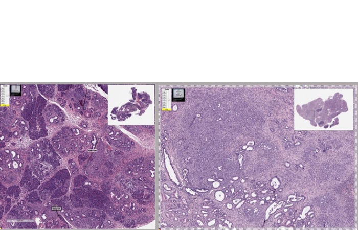Le mébendazole agit de manière similaire dans le cancer du pancréas en détruisant la structure des cellules cancéreuses et en réduisant l'inflammation (Visuel Tara Williamson). Le mébendazole agit de manière similaire dans le cancer du pancréas en détruisant la structure des cellules cancéreuses et en réduisant l'inflammation (Visuel Tara Williamson).