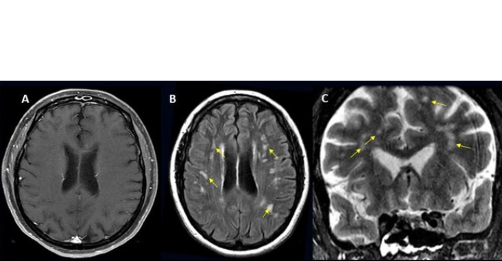 Imagerie du cerveau d'une patiente COVID-19 ayant développé des maux de tête, une forte fièvre puis une ptose de la paupière supérieure droite (Visuel Radiological Society of North America et Scott H. Faro, M.D.) 