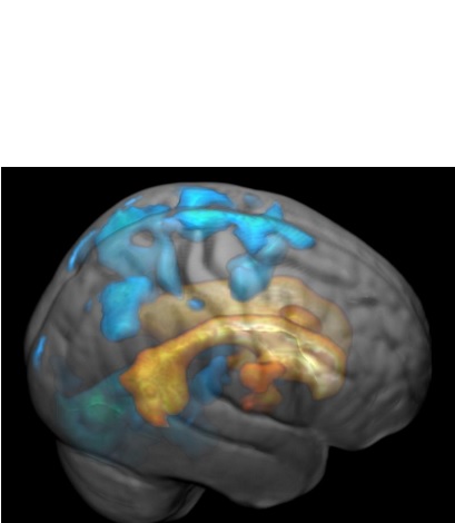 Ces marques blanches se propagent à la surface du cerveau et augmentent en volume Ces marques blanches se propagent à la surface du cerveau et augmentent en volume