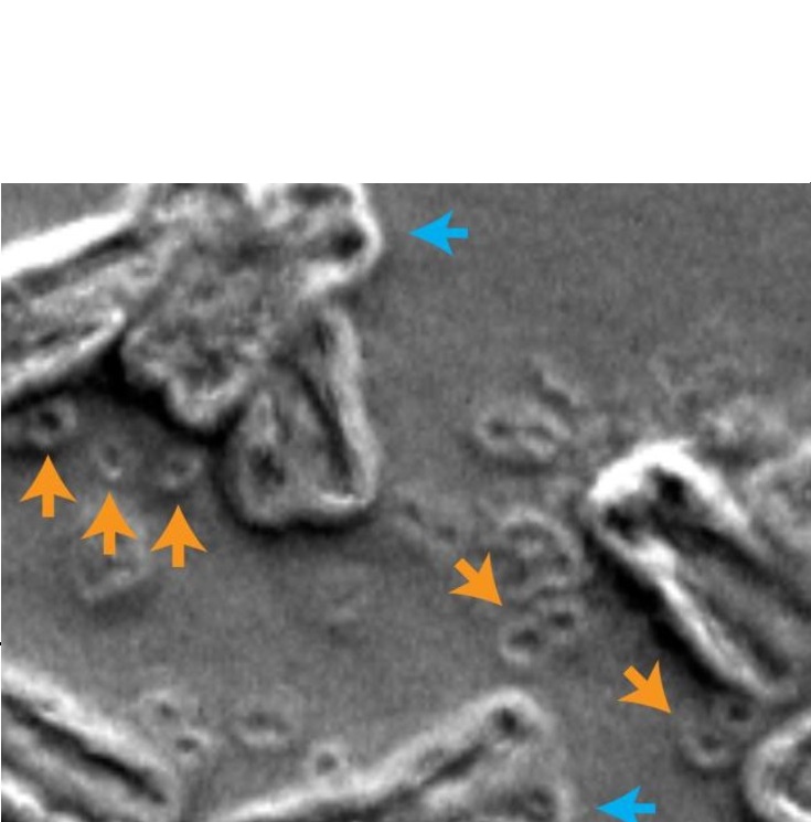 Ce phénomène connu sous le nom de « chromothripsie » est caractérisé par une rupture des chromosomes (flèches bleues sur schéma) et une circulation d'ADN extra-chromosomique (ADNc) (flèches orange)(Visuel Paul Mischel, UC San Diego) Ce phénomène connu sous le nom de « chromothripsie » est caractérisé par une rupture des chromosomes (flèches bleues sur schéma) et une circulation d'ADN extra-chromosomique (ADNc) (flèches orange)(Visuel Paul Mischel, UC San Diego)