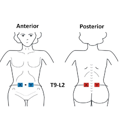 La thérapie consiste en une stimulation électrique sur l'estomac et le dos pendant 1 heure chaque jour 