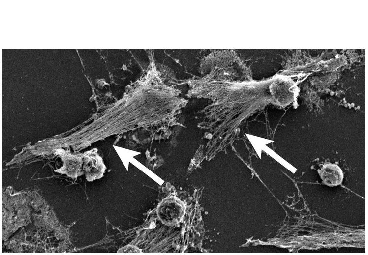 Les neutrophiles explosent et libèrent ces filets antimicrobiens composés de fibres d'ADN (Voir visuel noir et blanc), des enzymes bactéricides et des molécules pro-inflammatoires. Les neutrophiles explosent et libèrent ces filets antimicrobiens composés de fibres d'ADN (Voir visuel noir et blanc), des enzymes bactéricides et des molécules pro-inflammatoires.
