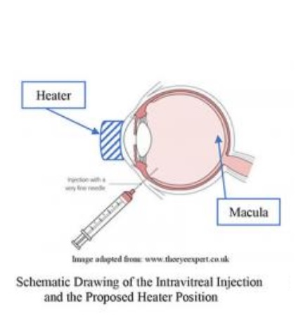 Une étape de chauffage léger après l'injection pourrait optimiser l'efficacité des anti-VEGF Une étape de chauffage léger après l'injection pourrait optimiser l'efficacité des anti-VEGF