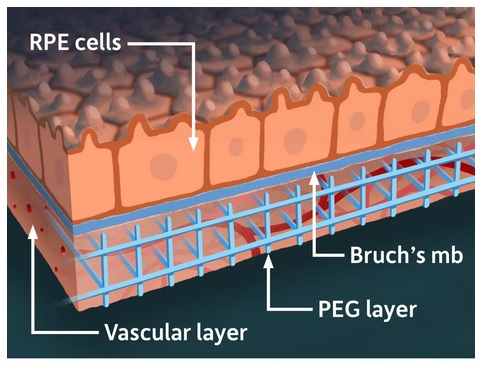 Le modèle combine des tissus rétiniens dérivés de cellules souches et des réseaux vasculaires de patients humains reproduits avec des matériaux synthétiques, dans une « matrice » tridimensionnelle (Illustration de l'Université de Rochester / Michael Osadciw) Le modèle combine des tissus rétiniens dérivés de cellules souches et des réseaux vasculaires de patients humains reproduits avec des matériaux synthétiques, dans une « matrice » tridimensionnelle (Illustration de l'Université de Rochester / Michael Osadciw)