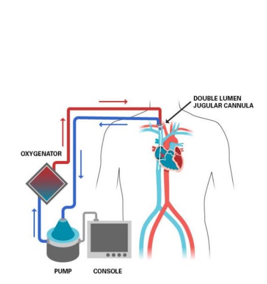 ECMO : Visuel University of Michigan