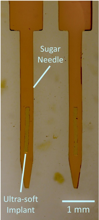 L'aiguille en sucre permet d'acheminer l'implant au site cible puis se dissout en quelques secondes, libérant ainsi l’implant en silicone (Visuel The Neuro) L'aiguille en sucre permet d'acheminer l'implant au site cible puis se dissout en quelques secondes, libérant ainsi l’implant en silicone (Visuel The Neuro)