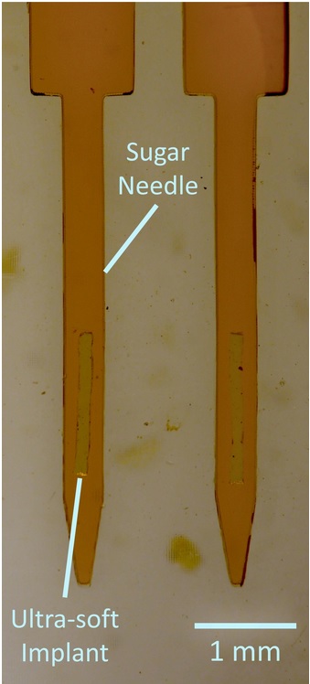  L'aiguille en sucre permet d'acheminer l'implant au site cible puis se dissout en quelques secondes, libérant ainsi l’implant en silicone (Visuel The Neuro)