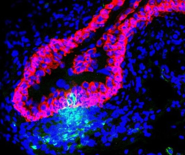 Les cellules immunitaires (vertes) infiltrant la muqueuse de la vessie (rouge) combattent les bactéries envahissantes. Noyaux d'autres cellules tissulaires de la vessie en bleu (Visuel Duke Health) Les cellules immunitaires (vertes) infiltrant la muqueuse de la vessie (rouge) combattent les bactéries envahissantes. Noyaux d'autres cellules tissulaires de la vessie en bleu (Visuel Duke Health)
