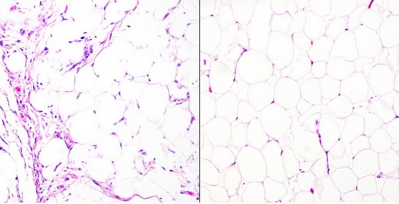 Un liposarcome (à gauche sur visuel) vs un lipome bénin (à droite) (Visuel Tony Ng, MD, PhD, The University of British Columbia)