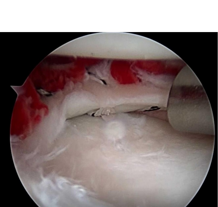 Vue arthroscopique après implantation du caillot de fibrine dérivé de la moelle osseuse et réparation du ménisque du genou droit (Visuel H. Nakamura & Y. Hashimoto, Orthopedics, Osaka City University) Vue arthroscopique après implantation du caillot de fibrine dérivé de la moelle osseuse et réparation du ménisque du genou droit (Visuel H. Nakamura & Y. Hashimoto, Orthopedics, Osaka City University)