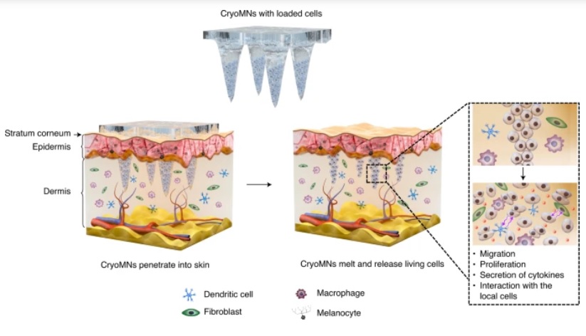 Les «cryomicroneedles» sont des micro-aiguilles « glacées », longues de moins d’1mm, montées ici sous forme de patch cutané capable de charger, stocker et délivrer par voie intradermique des cellules vivantes (Visuel Chang et al. /DOI number: 10.1038/s41551-021-00720-1) Les «cryomicroneedles» sont des micro-aiguilles « glacées », longues de moins d’1mm, montées ici sous forme de patch cutané capable de charger, stocker et délivrer par voie intradermique des cellules vivantes (Visuel Chang et al. /DOI number: 10.1038/s41551-021-00720-1)