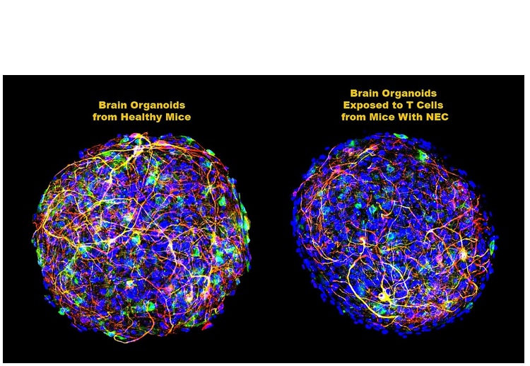 Sur des organoïdes, des cellules cérébrales de souris cultivées en laboratoire pour simuler l'ensemble du cerveau, l’ajout de cellules T CD4 + dérivées du cerveau de souris atteintes de NEC induit l’augmentation d’un signal chimique spécifique des cellules T - une cytokine (protéine inflammatoire) connue sous le nom d'interféron-gamma (IFN-gamma) (Visuel C. Zhou, C. Sodhi and D. J. Hackam, Johns Hopkins Medicine) 