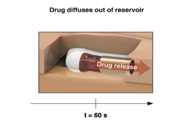 La capsule fournit également une dose de naloxone plus importante que les produits actuellement disponibles sur le marché, ce qui la rend plus efficace.