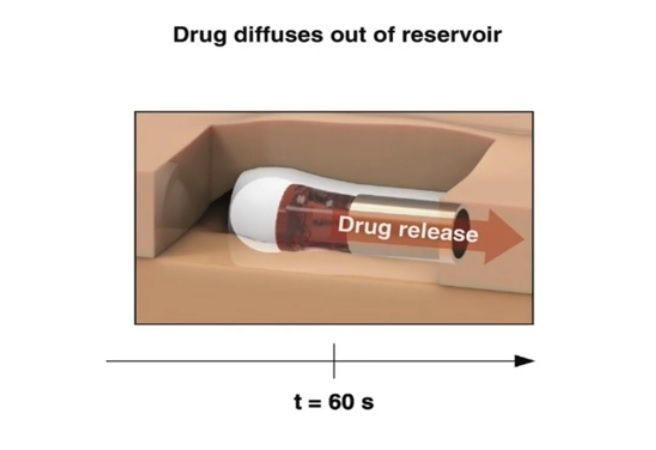 La capsule fournit également une dose de naloxone plus importante que les produits actuellement disponibles sur le marché, ce qui la rend plus efficace. La capsule fournit également une dose de naloxone plus importante que les produits actuellement disponibles sur le marché, ce qui la rend plus efficace.