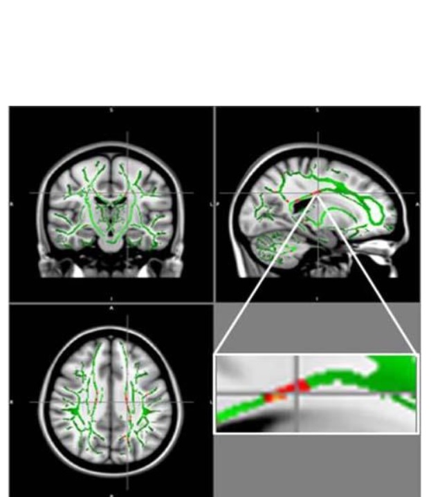 Ces réductions de FA sont identifiées principalement dans le corps calleux, un faisceau de fibres nerveuses qui relie les hémisphères gauche et droit du cerveau, dans le gyrus orbitofrontal moyen, une région du cerveau impliquée dans le contrôle des émotions et dans le circuit de récompense. Ces réductions de FA sont identifiées principalement dans le corps calleux, un faisceau de fibres nerveuses qui relie les hémisphères gauche et droit du cerveau, dans le gyrus orbitofrontal moyen, une région du cerveau impliquée dans le contrôle des émotions et dans le circuit de récompense.