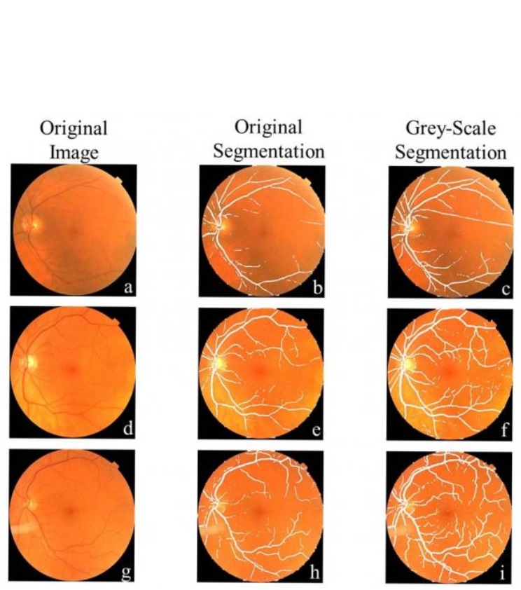 Le système d'apprentissage automatique a été programmé à l’aide d’images de l'arrière de l'œil de patients atteints de la maladie de Parkinson et de participants témoins (Radiological Society of North America) Le système d'apprentissage automatique a été programmé à l’aide d’images de l'arrière de l'œil de patients atteints de la maladie de Parkinson et de participants témoins (Radiological Society of North America)
