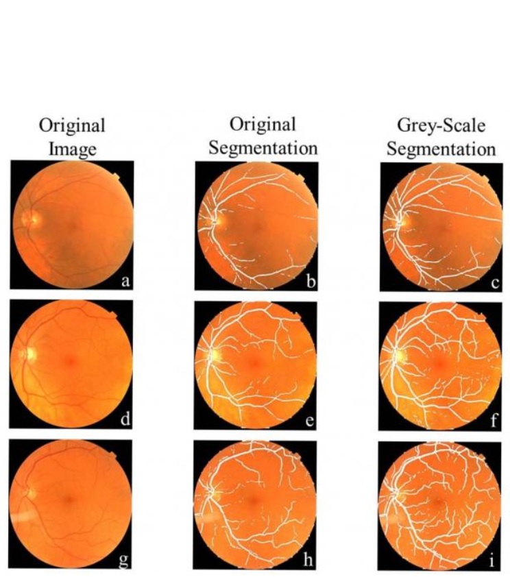 Le système d'apprentissage automatique a été programmé à l’aide d’images de l'arrière de l'œil de patients atteints de la maladie de Parkinson et de participants témoins (Radiological Society of North America)