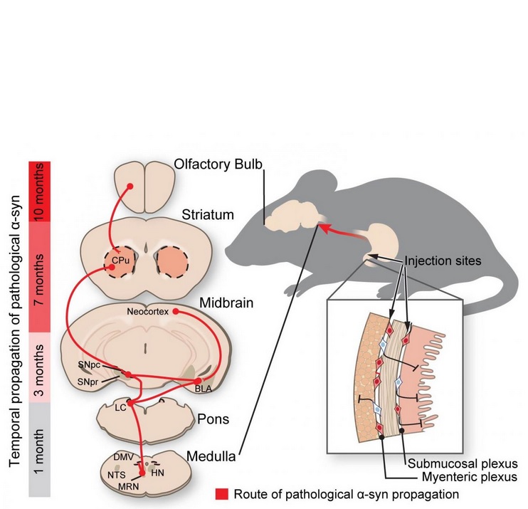 La protéine mal repliée progresse le long des nerfs reliant l'intestin et le cerveau, « comme si elle montait à l'échelle ». La protéine mal repliée progresse le long des nerfs reliant l'intestin et le cerveau, « comme si elle montait à l'échelle ».