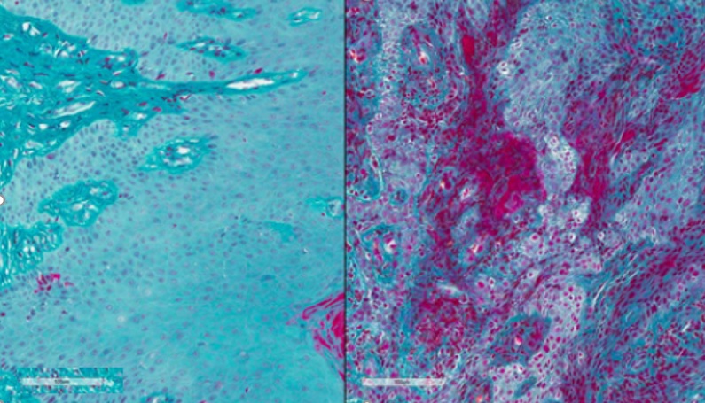 À ses débuts, la maladie parodontale provoque une rougeur et un gonflement (inflammation) des gencives (visuel de droite) (Visuel Lakmali Silva, NIDCR) À ses débuts, la maladie parodontale provoque une rougeur et un gonflement (inflammation) des gencives (visuel de droite) (Visuel Lakmali Silva, NIDCR)