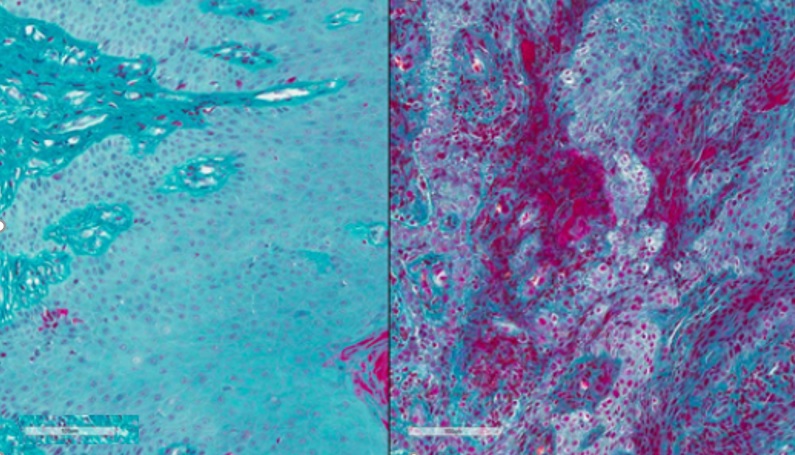 À ses débuts, la maladie parodontale provoque une rougeur et un gonflement (inflammation) des gencives (visuel de droite) (Visuel Lakmali Silva, NIDCR)