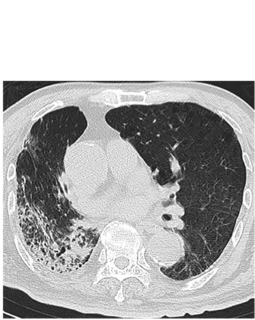 Les consolidations pulmonaires ou zones hypoéchogènes ressemblant à des tissus, reflétant un débit d'air très réduit et une quantité accrue d'exsudat cellulaire inflammatoire sont plus fréquemment rencontrées dans les cas graves et critiques Les consolidations pulmonaires ou zones hypoéchogènes ressemblant à des tissus, reflétant un débit d'air très réduit et une quantité accrue d'exsudat cellulaire inflammatoire sont plus fréquemment rencontrées dans les cas graves et critiques