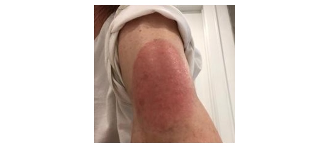 Certaines réactions cutanées importantes, plus sévères, rouges, parfois en relief, qui démangent ou douloureuses n'ont jamais été complètement caractérisées ni expliquées(Visuel Massachusetts General Hospital) Certaines réactions cutanées importantes, plus sévères, rouges, parfois en relief, qui démangent ou douloureuses n'ont jamais été complètement caractérisées ni expliquées(Visuel Massachusetts General Hospital)
