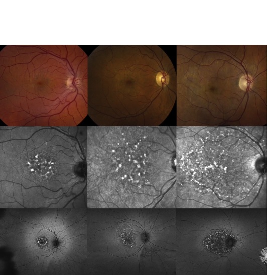 Visuel American Academy of Ophthalmology