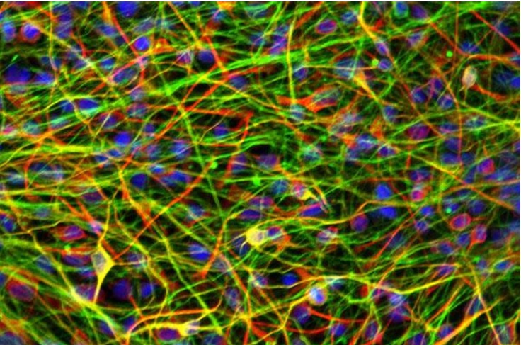 Neurones dérivés de cellules souches pluripotentes induites d'un patient schizophrène (Visuel Laura Stertz, PhD / UTHealth)