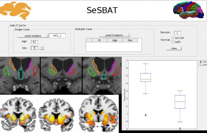 Un programme informatique nommé SeSBAT pour Single Subject Brain Analysis Toolbox Un programme informatique nommé SeSBAT pour Single Subject Brain Analysis Toolbox