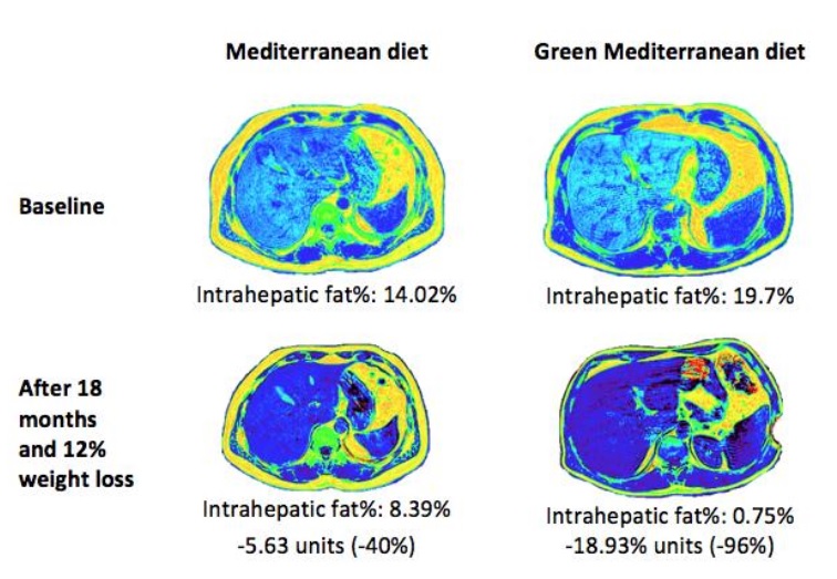 Ces polyphénols, présents dans les noix et le Mankai semblent jouer un rôle majeur dans la réduction de la graisse du foie (Visuel Gut 2021). Ces polyphénols, présents dans les noix et le Mankai semblent jouer un rôle majeur dans la réduction de la graisse du foie (Visuel Gut 2021).