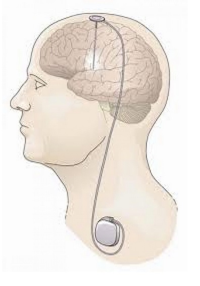 La stimulation cérébrale profonde est une procédure neurochirurgicale impliquant le placement d'un neurostimulateur qui envoie des impulsions électriques à haute fréquence à travers des électrodes implantées au plus profond du cerveau La stimulation cérébrale profonde est une procédure neurochirurgicale impliquant le placement d'un neurostimulateur qui envoie des impulsions électriques à haute fréquence à travers des électrodes implantées au plus profond du cerveau