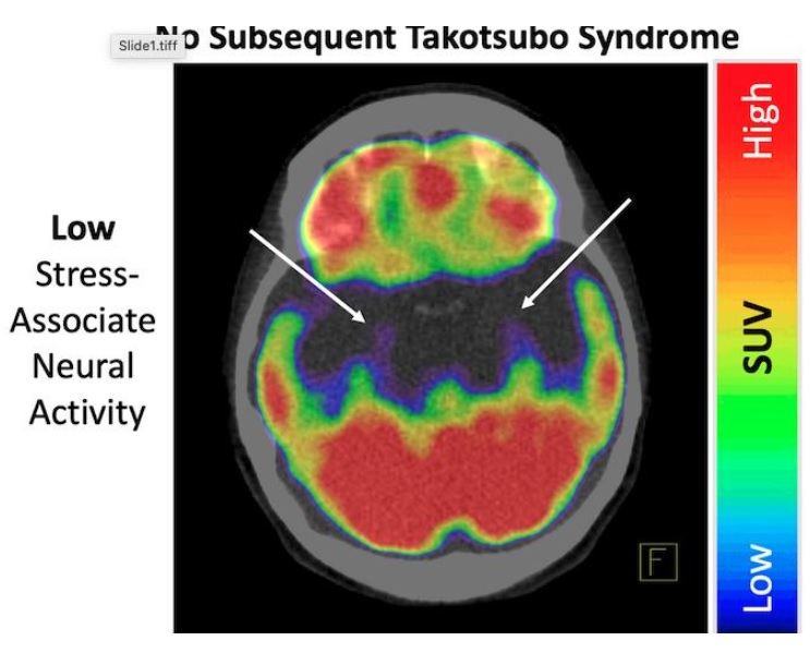 Le TTS, d‘ailleurs connu sous le nom de syndrome du «cœur brisé», se caractérise par un affaiblissement soudain et temporaire des muscles cardiaques ce qui fait gonfler le ventricule gauche du cœur vers le bas tandis que le cou reste étroit, créant une forme ressemblant à un piège à poulpe japonais (Visuel European Heart Journal)