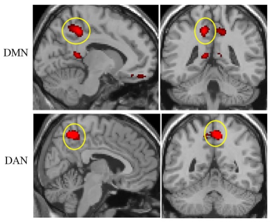 Le précuneus est plus fortement connecté au réseau d'attention dorsal (DAN) et moins connecté au réseau de mode par défaut (DMN). Le précuneus est plus fortement connecté au réseau d'attention dorsal (DAN) et moins connecté au réseau de mode par défaut (DMN).