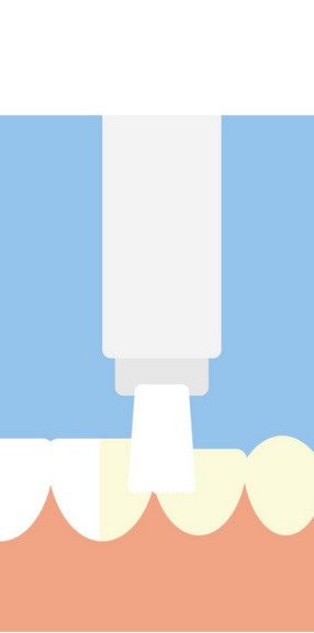 La technique de blanchiment dentaire doit donc bien veiller protéger les gencives et à adapter la concentration de peroxyde dans le gel appliqué sur l’émail dentaire. La technique de blanchiment dentaire doit donc bien veiller protéger les gencives et à adapter la concentration de peroxyde dans le gel appliqué sur l’émail dentaire.