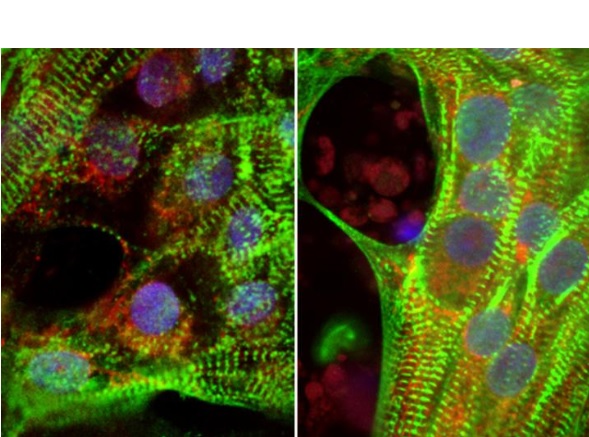 Les cardiomyocytes cultivés à partir de cellules souches présentent des fibres musculaires moins robustes (en vert) en cas de niveaux de glucose élevés (à gauche) vs une glycémie normale (à droite).