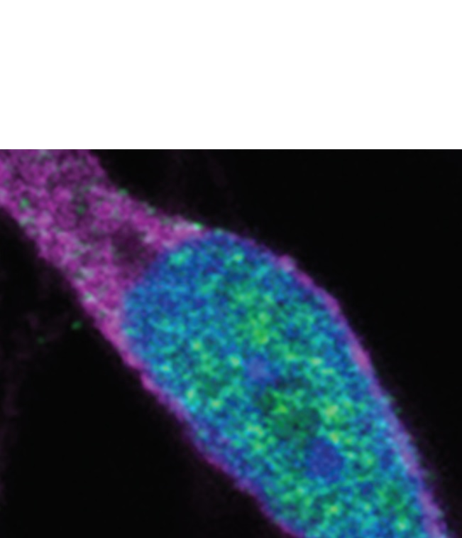 Dans les neurones cultivés à partir de cellules souches dérivées de patients atteints de SLA (en rouge), la protéine CHMP7 (en vert) est mal localisée dans le noyau (en bleu) (Visuel Laboratoire Rothstein).