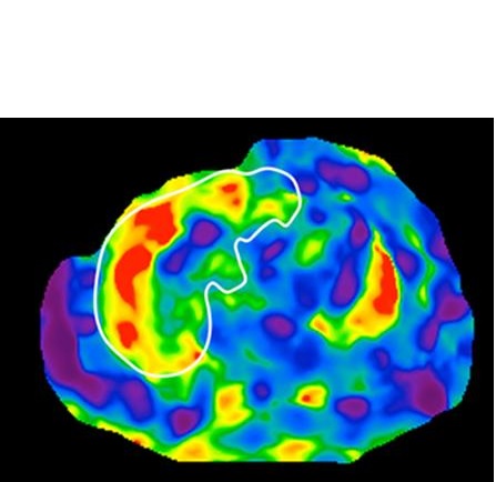 scanner du foie avec cirrhose