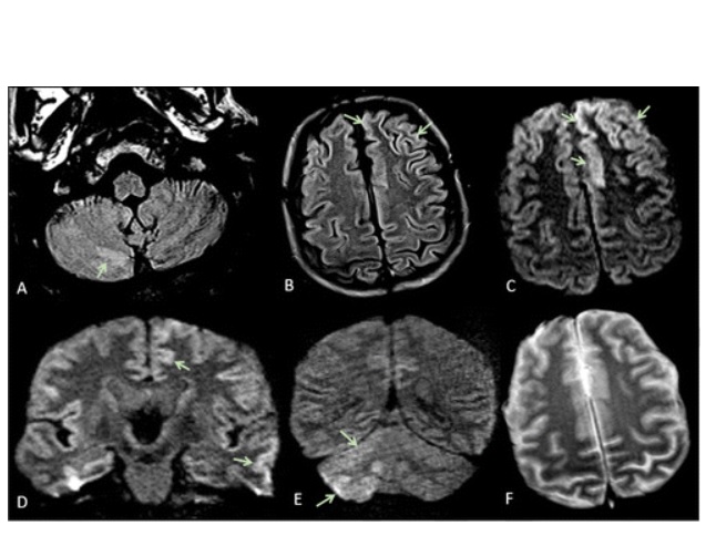 L'étude montre que ces complications neurologiques peuvent inclure plusieurs types d’encéphalopathie dont le syndrome d'encéphalopathie réversible postérieure (avec anomalies radiologiques cérébrales bilatérales réversibles- voir visuel ci-contre), l'encéphalopathie hypoxique ischémique ou encore une exacerbation de la maladie démyélinisante. L'étude montre que ces complications neurologiques peuvent inclure plusieurs types d’encéphalopathie dont le syndrome d'encéphalopathie réversible postérieure (avec anomalies radiologiques cérébrales bilatérales réversibles- voir visuel ci-contre), l'encéphalopathie hypoxique ischémique ou encore une exacerbation de la maladie démyélinisante.
