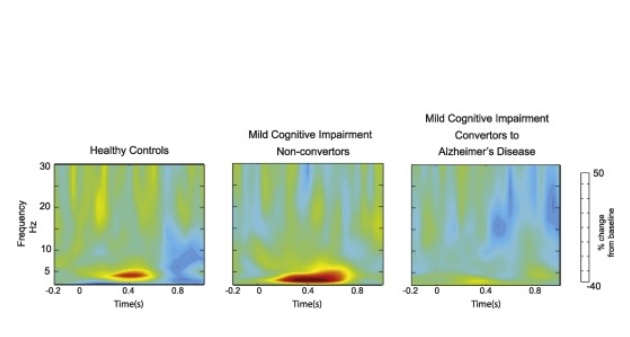 Une réponse cérébrale aberrante chez les sujets qui vont développer la maladie d'Alzheimer, mais intacte chez les patients stables Une réponse cérébrale aberrante chez les sujets qui vont développer la maladie d'Alzheimer, mais intacte chez les patients stables