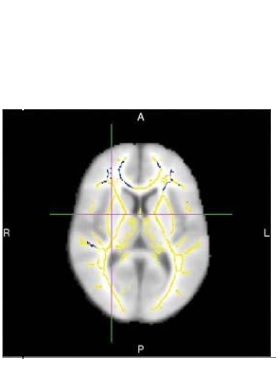 Les lésions de la substance blanche apparaissent ici en bleu