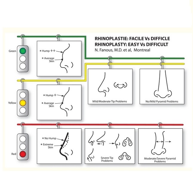 Des approches simples et systématiques ont été documentées dans la littérature (Canadian Journal of Plastic Surgery 2008 Predicting the results of rhinoplasty before surgery: Easy noses versus difficult noses) Des approches simples et systématiques ont été documentées dans la littérature (Canadian Journal of Plastic Surgery 2008 Predicting the results of rhinoplasty before surgery: Easy noses versus difficult noses)