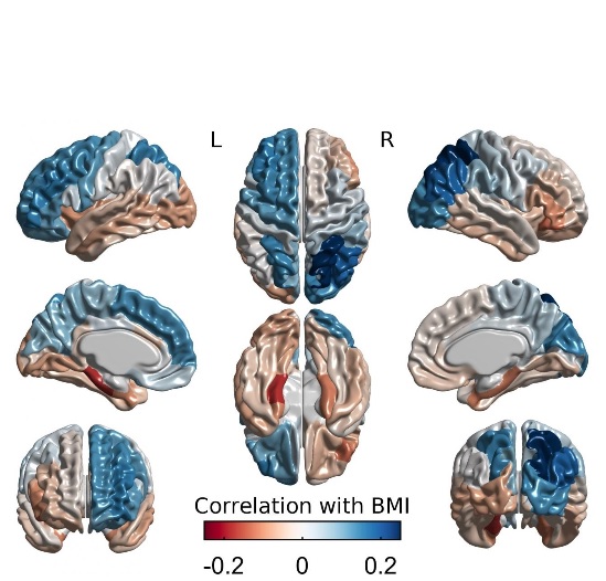  L’étude, par IRM associe l'épaisseur corticale à l'IMC (positivement : zones bleues et négativement : zones grises).